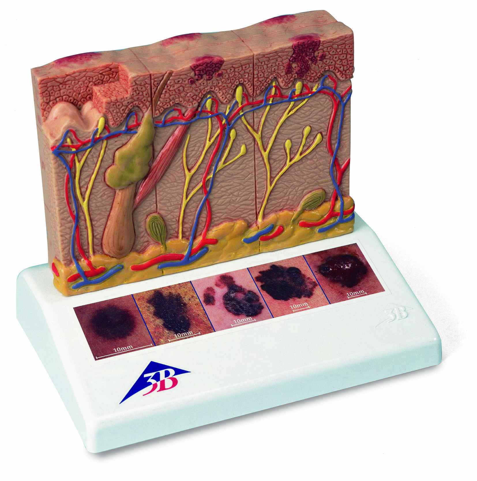 Huidkanker 5 stadia 8x vergroot