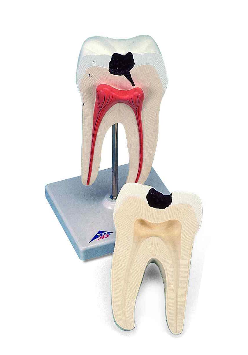 Model kies met caries