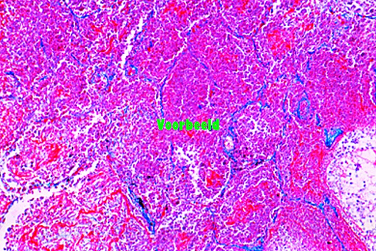 Necrotische (kazige) longontsteking