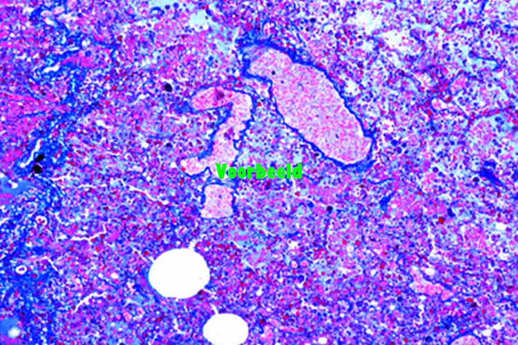 Influenzale longontsteking