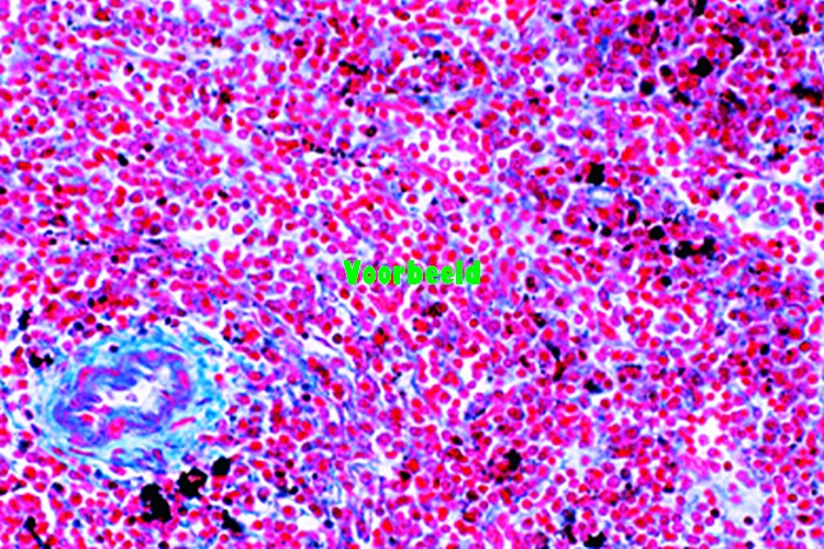 Malaria melanemie van milt