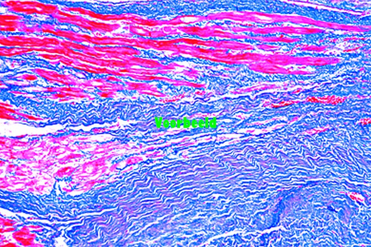 Cardiale callositeit