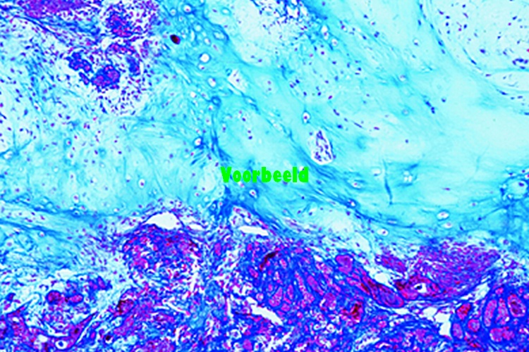 Fibroepitheliale gemengde tumor van paro