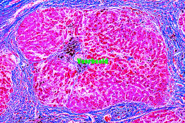 Pigmentaire levercirrose