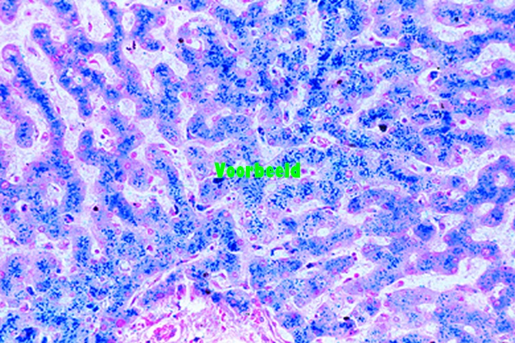 Hemosiderose van de lever