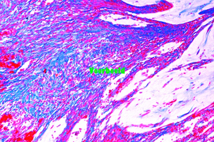 Adenocarcinoom van de dikke darm