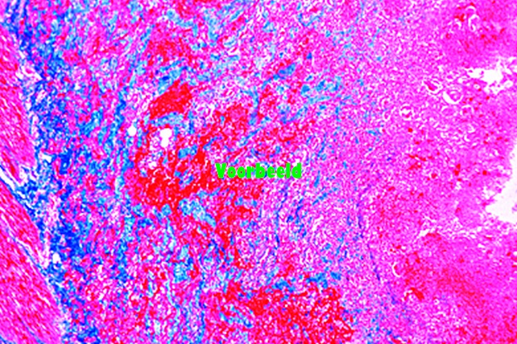 Colitis dysenterica Shiga-Kruse