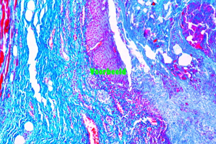 Necrotische slokdarmontsteking
