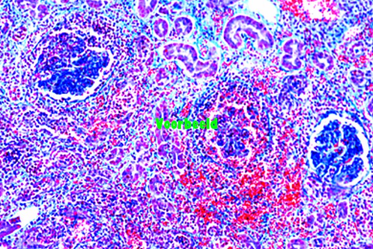 Septic embolic nephritis