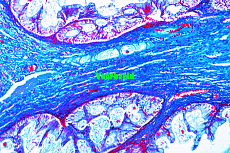 Cystadenoma papilliferum of ovary