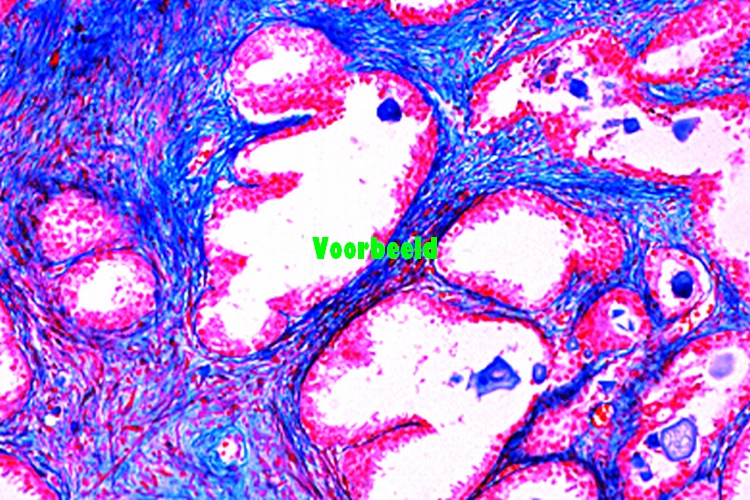 Hypertrophy of the prostate