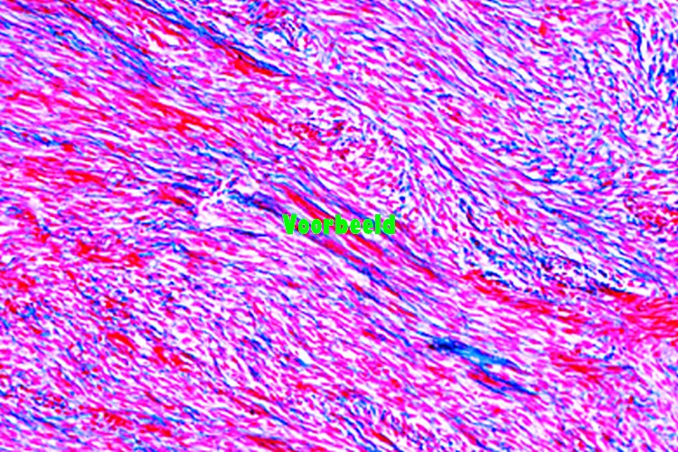 Spindle cell sarcoma