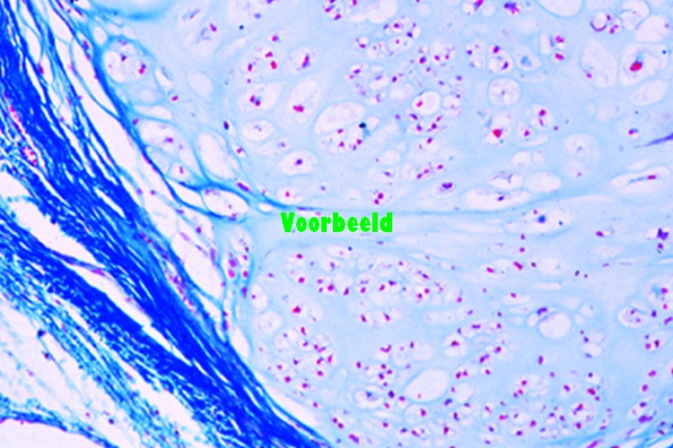 Chondroma of pubic bone