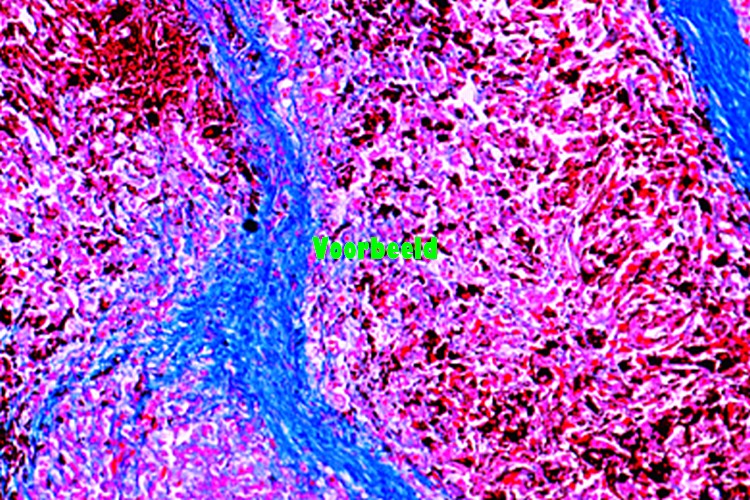 Melanosarcoma of skin